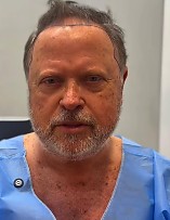 Blairo passa por transplante capilar e faz piada sobre calvície; veja vídeo