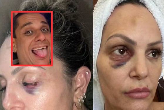 Débora Sander foi agredida pelo ex-namorado, Sanderson Ferreira, em agosto de 2024