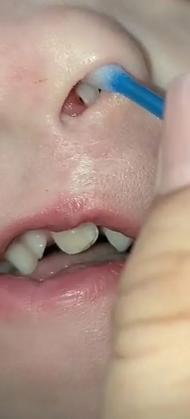 A criança precisou passar por um procedimento cirúrgico para a retirada do dente