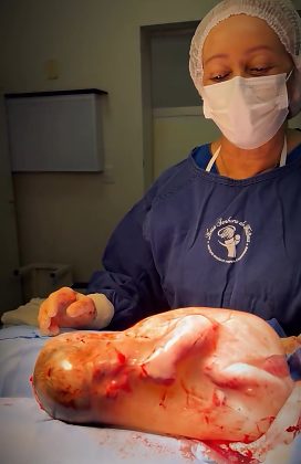 O nascimento de forma rara ocorreu em Sorriso.